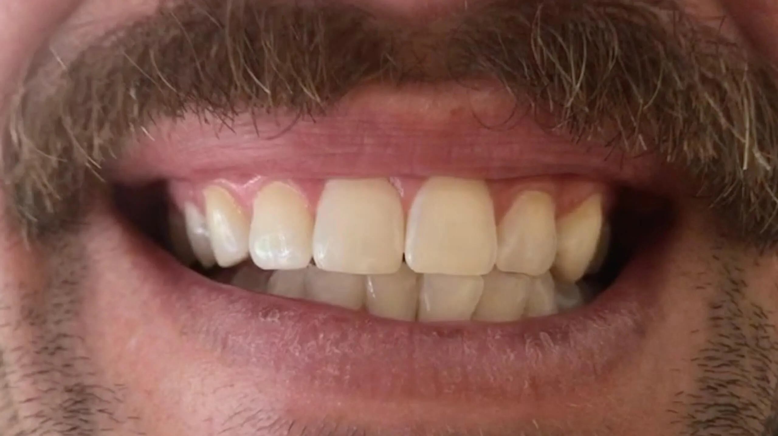 30288 teeth whitening vero beach dental office