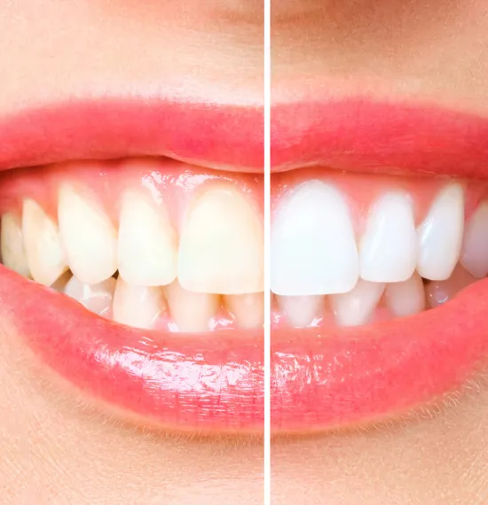 30288 teeth whitening vero beach healthy teeth