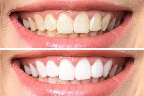 30289 professional teeth whitening