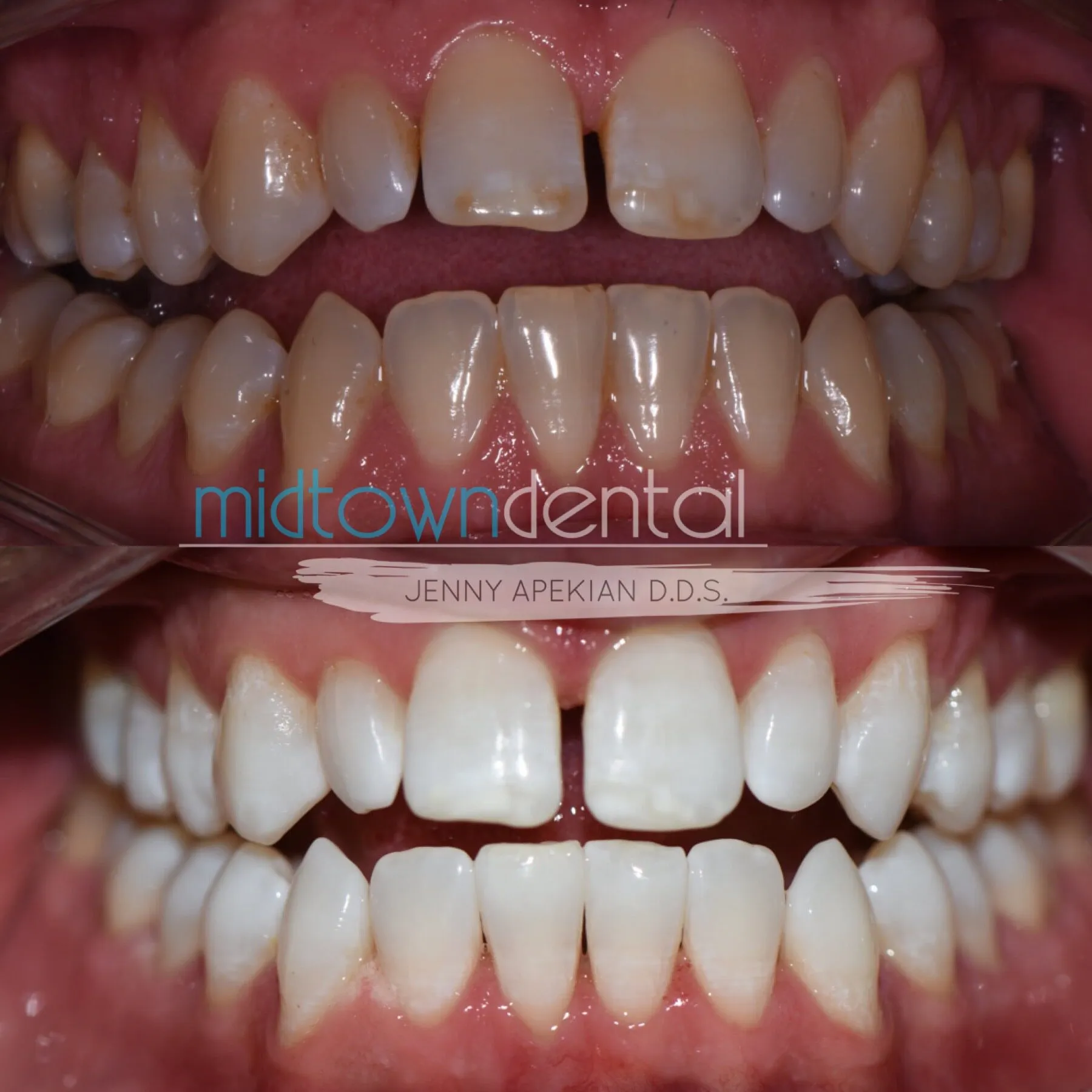 30289 teeth whitening products