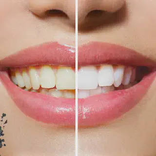 /img/30298-charcoal-powder-teeth-whitening-7.webp
