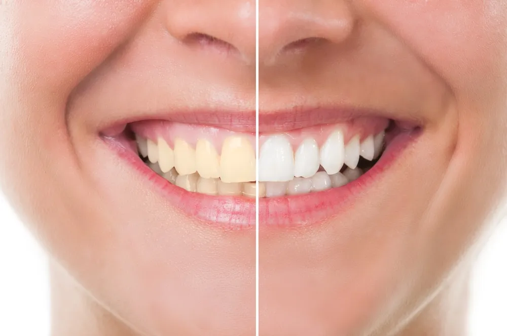 /img/30299-teeth-whitening-comparison.webp