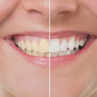 /img/30299-teeth-whitening-comparison.webp