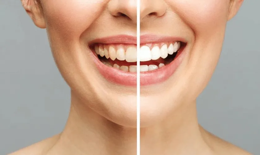 30301 teeth whitening aftercare image5