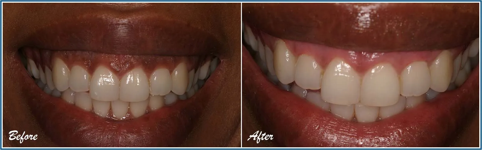 30304 teeth whitening consultation