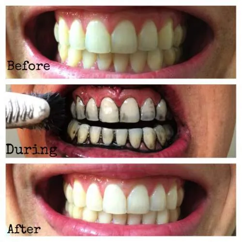 30306 charcoal teeth whitening before after