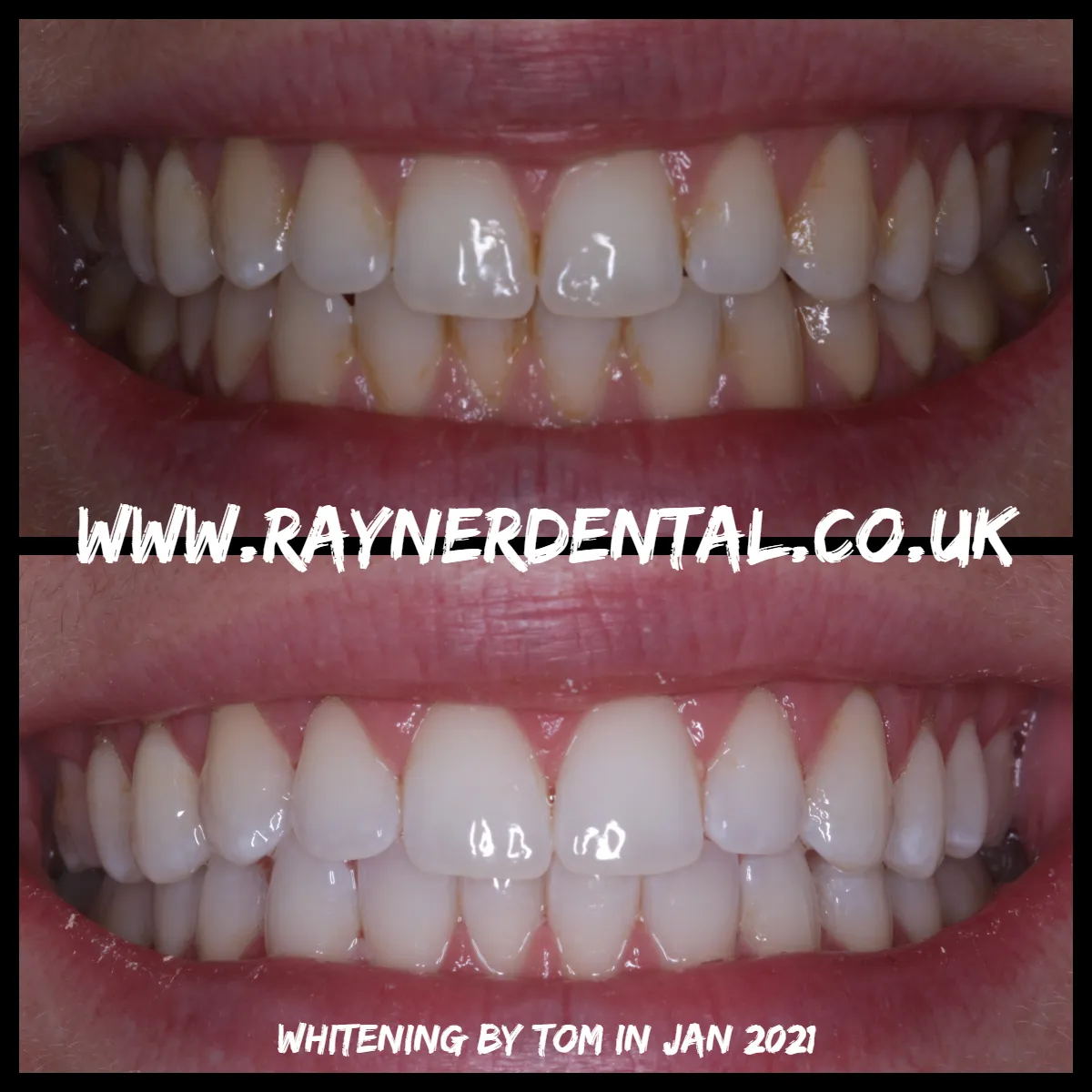 30307 in office teeth whitening