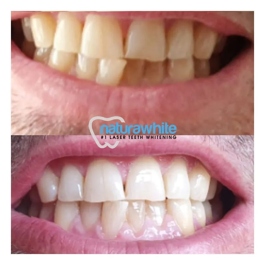 30307 teeth whitening procedure