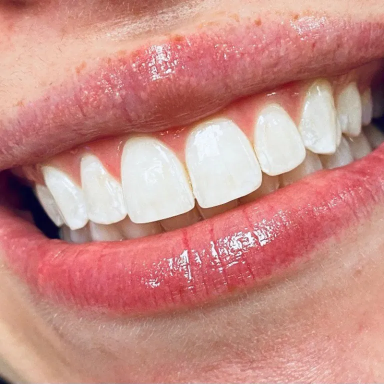 30316 in office teeth whitening procedure