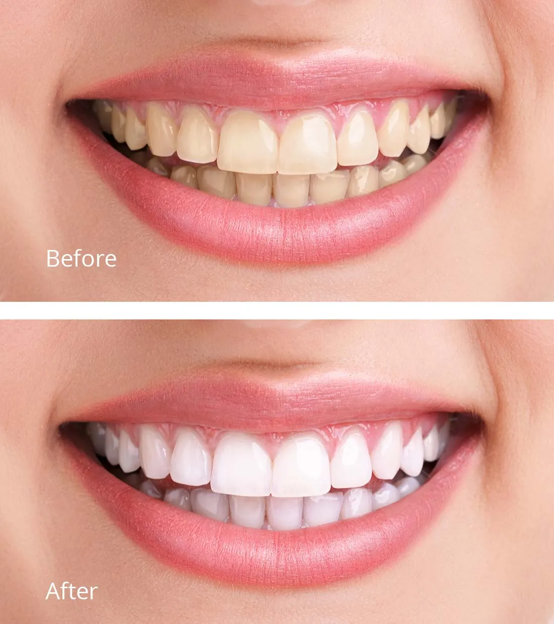 30316 take home teeth whitening kit