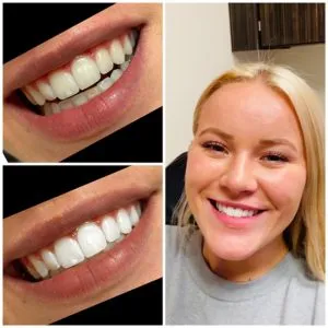 30316 teeth discoloration causes