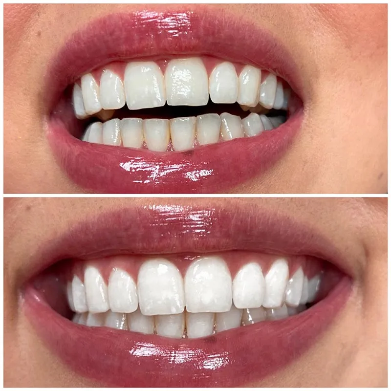 30316 teeth whitening fort worth smiling