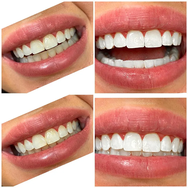 30316 whitening strips application