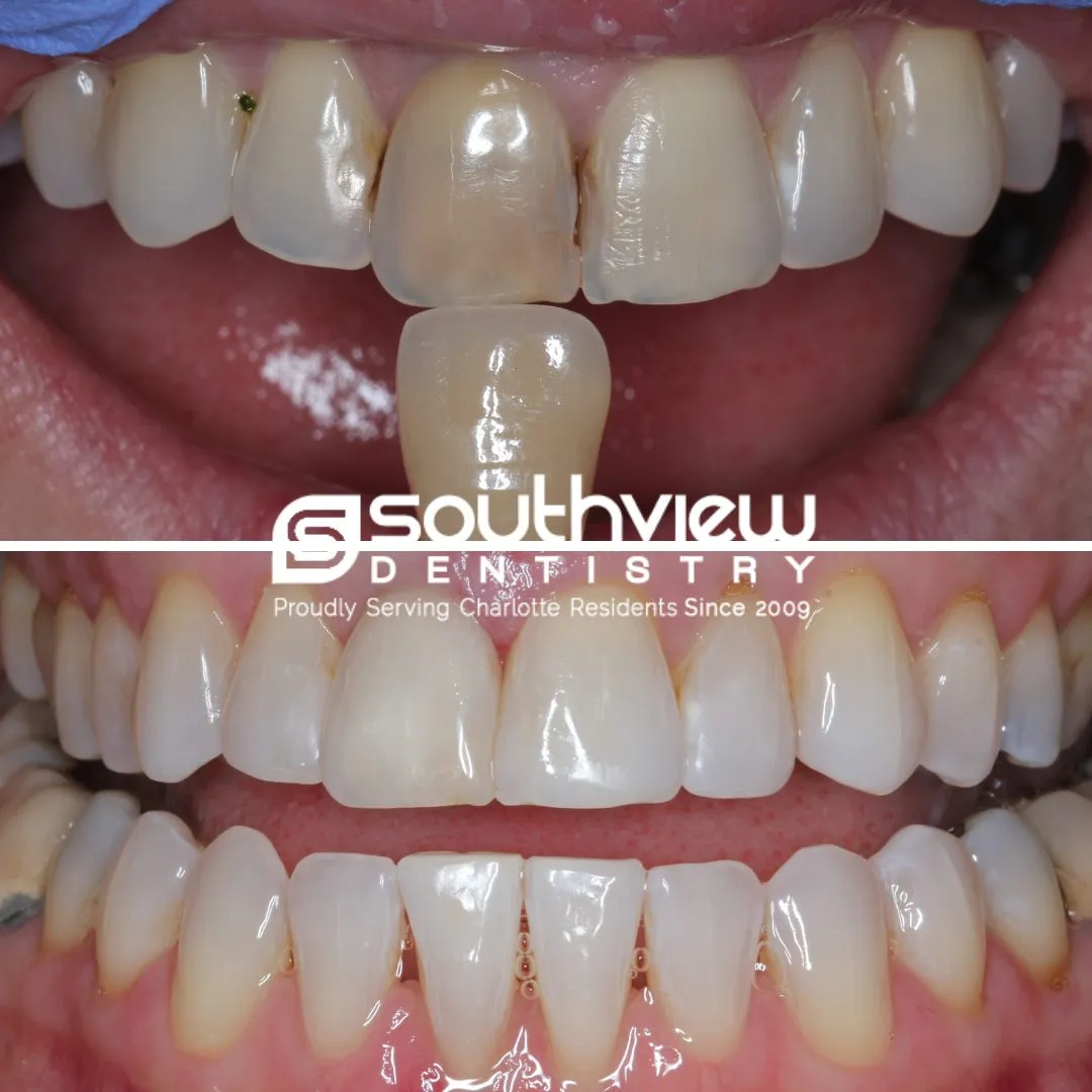 30320 maintaining white teeth