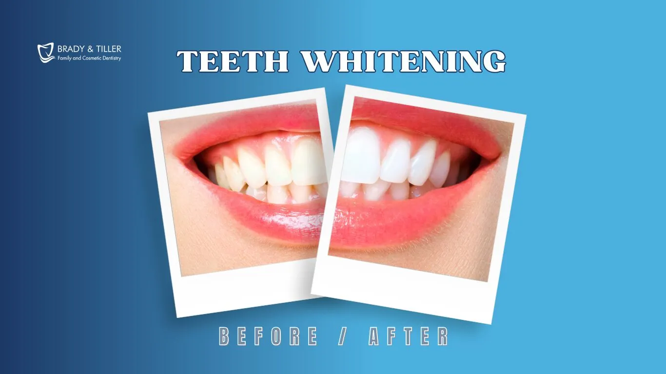 30320 teeth whitening duration