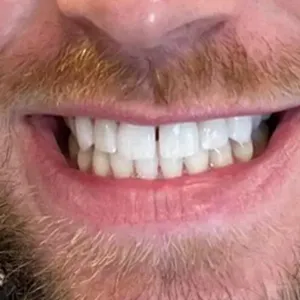 30325 in office teeth whitening spring tx