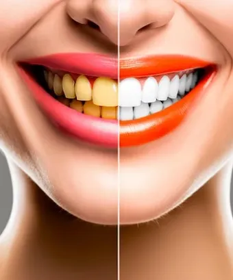 30325 teeth whitening spring tx cost