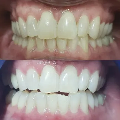 30325 teeth whitening spring tx options