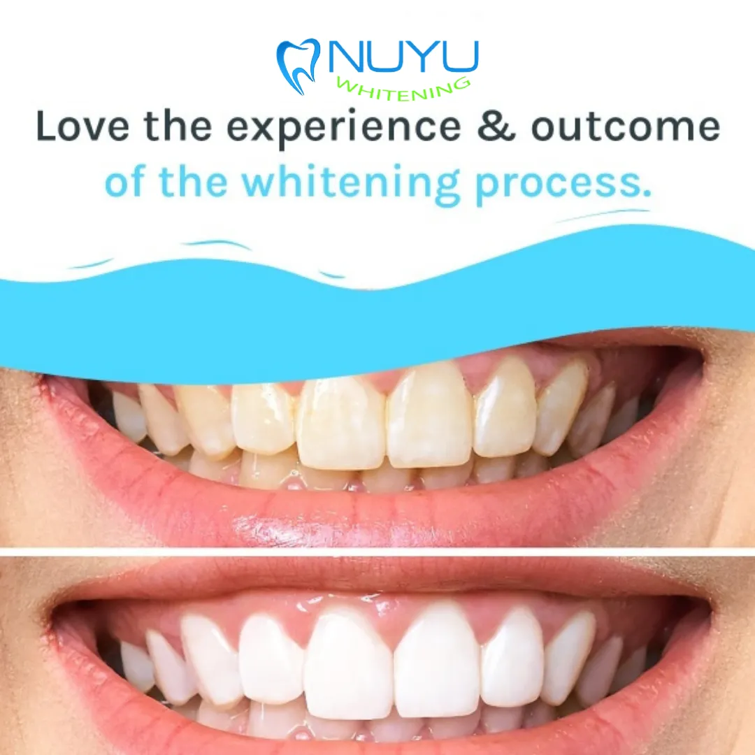 30325 teeth whitening spring tx procedure