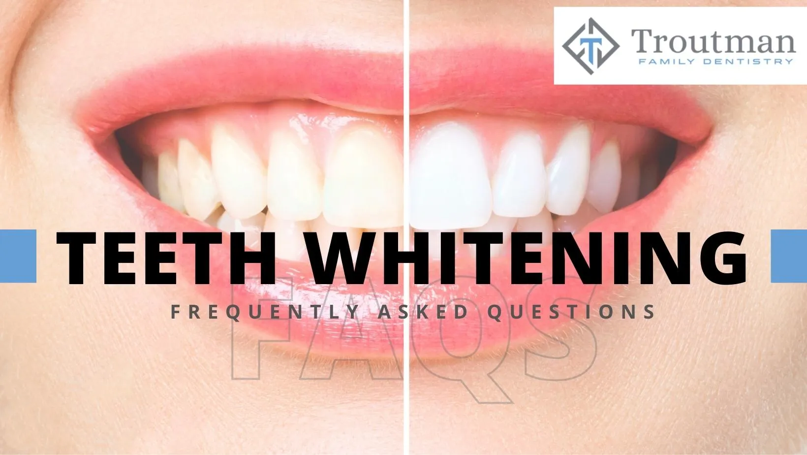 30327 dentist consultation teeth whitening