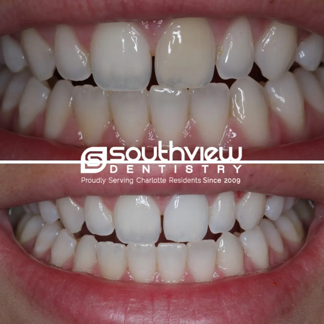 /img/30327-maintaining-teeth-whitening.webp
