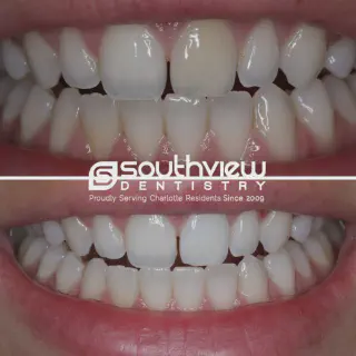 /img/30327-maintaining-teeth-whitening.webp