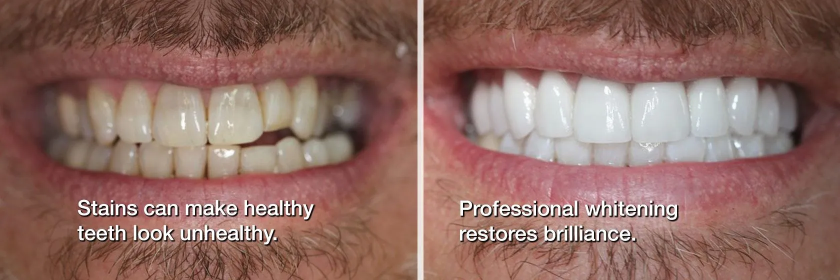 30327 teeth whitening gastonia nc before after