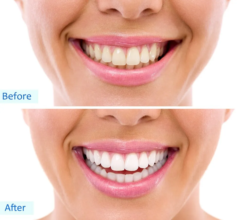 30329 at home teeth whitening