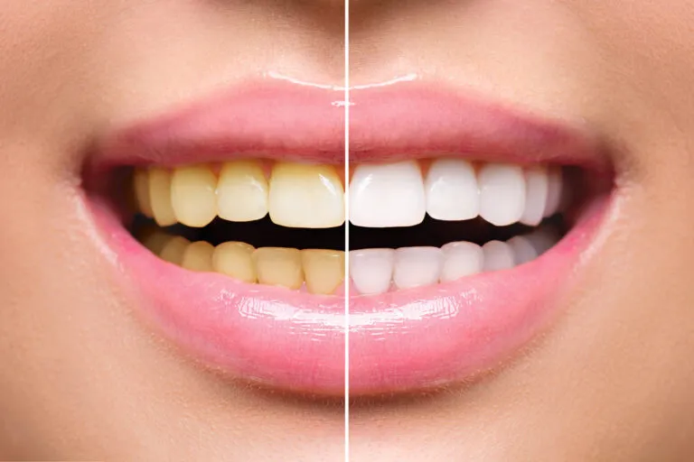 30329 in office teeth whitening