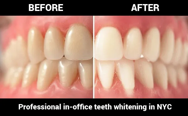 /img/30329-teeth-whitening-maintenance.webp