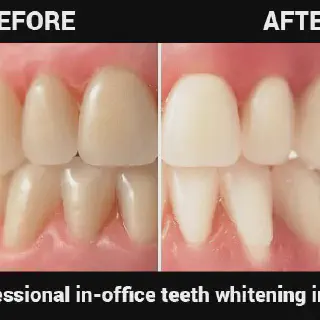 /img/30329-teeth-whitening-maintenance.webp