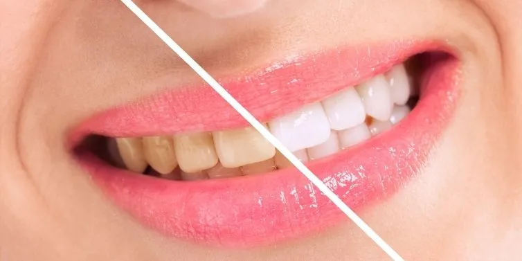 30330 allergic reaction teeth whitening
