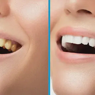 /img/30330-consult-dentist-teeth-whitening.webp
