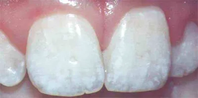 30330 uneven whitening results