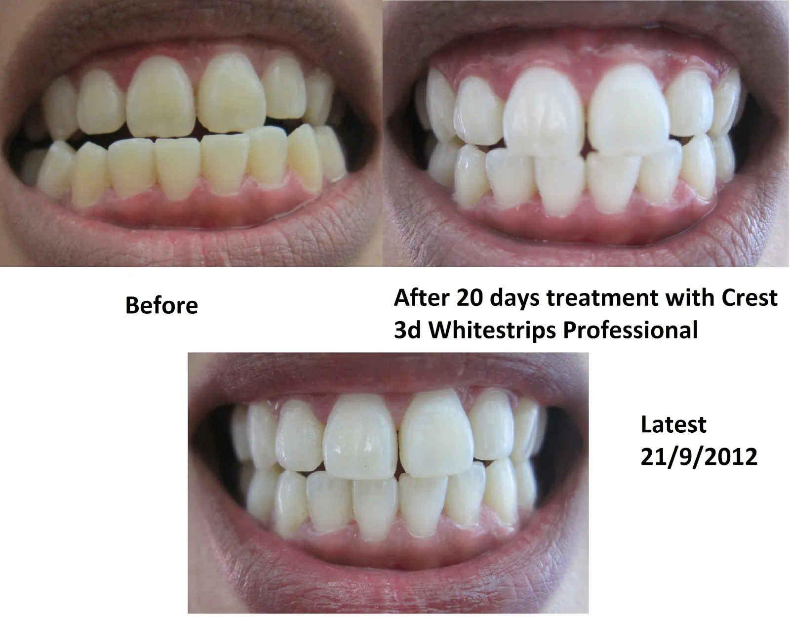 30332 crest whitening strips application