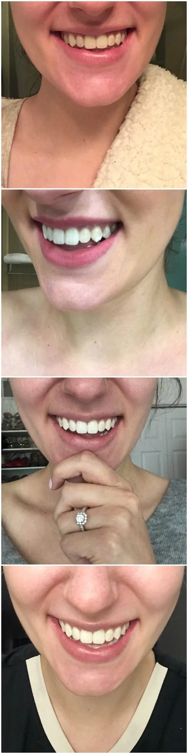 30332 crest whitening strips before after 2