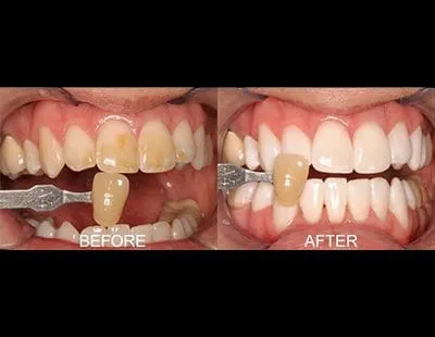 30333 tooth discoloration causes