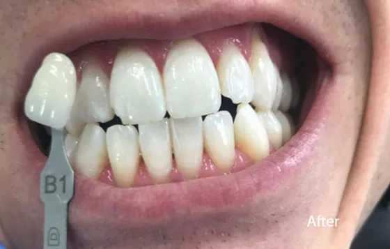 30338 professional teeth whitening