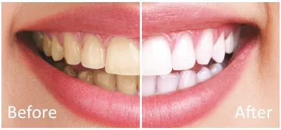 30339 teeth whitening toothpaste