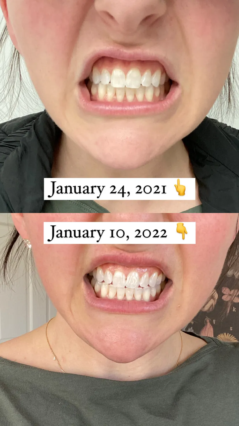 30340 lumineux whitening strips smile