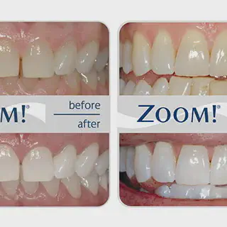 /img/30342-teeth-whitening-saginaw-mi-image7.webp