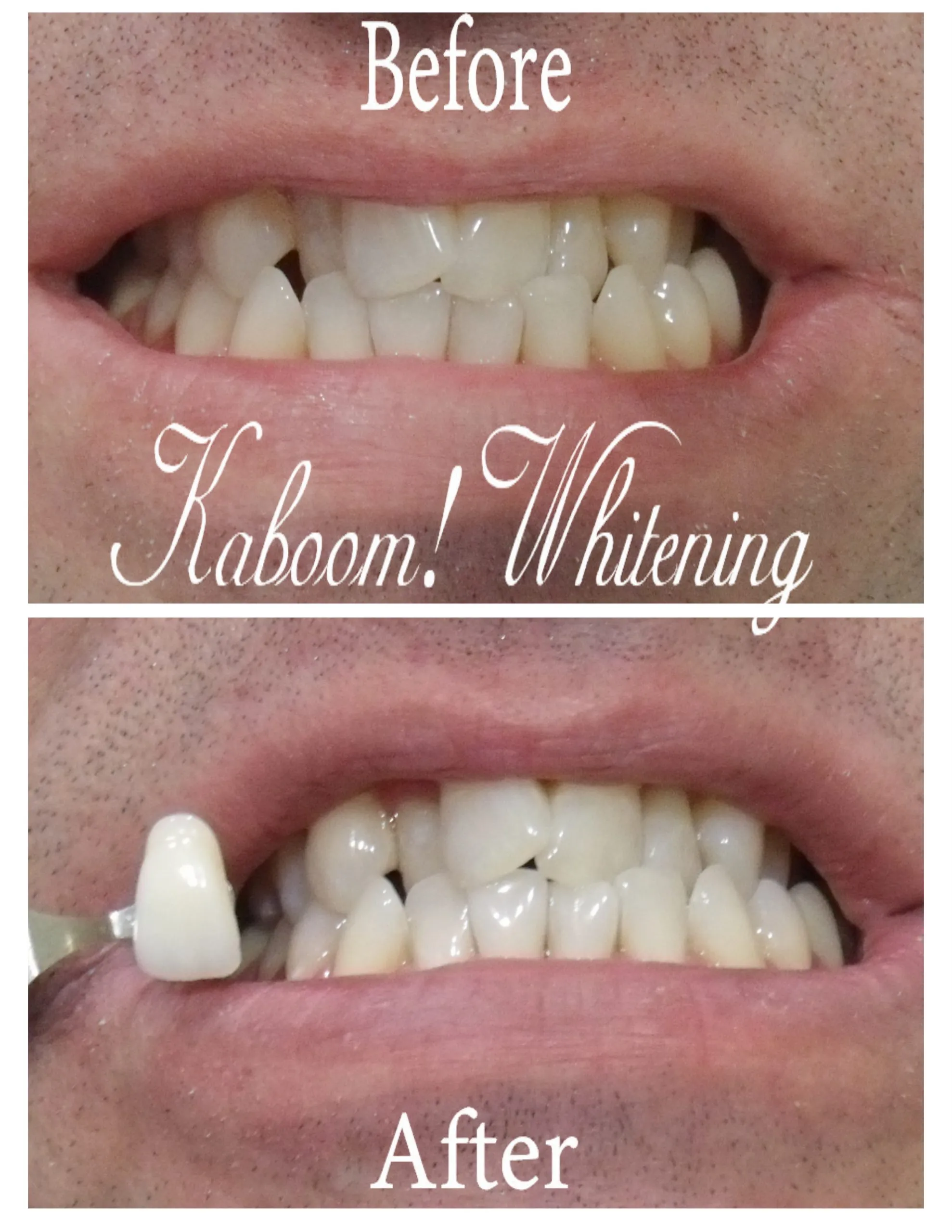 30343 teeth whitening aftercare