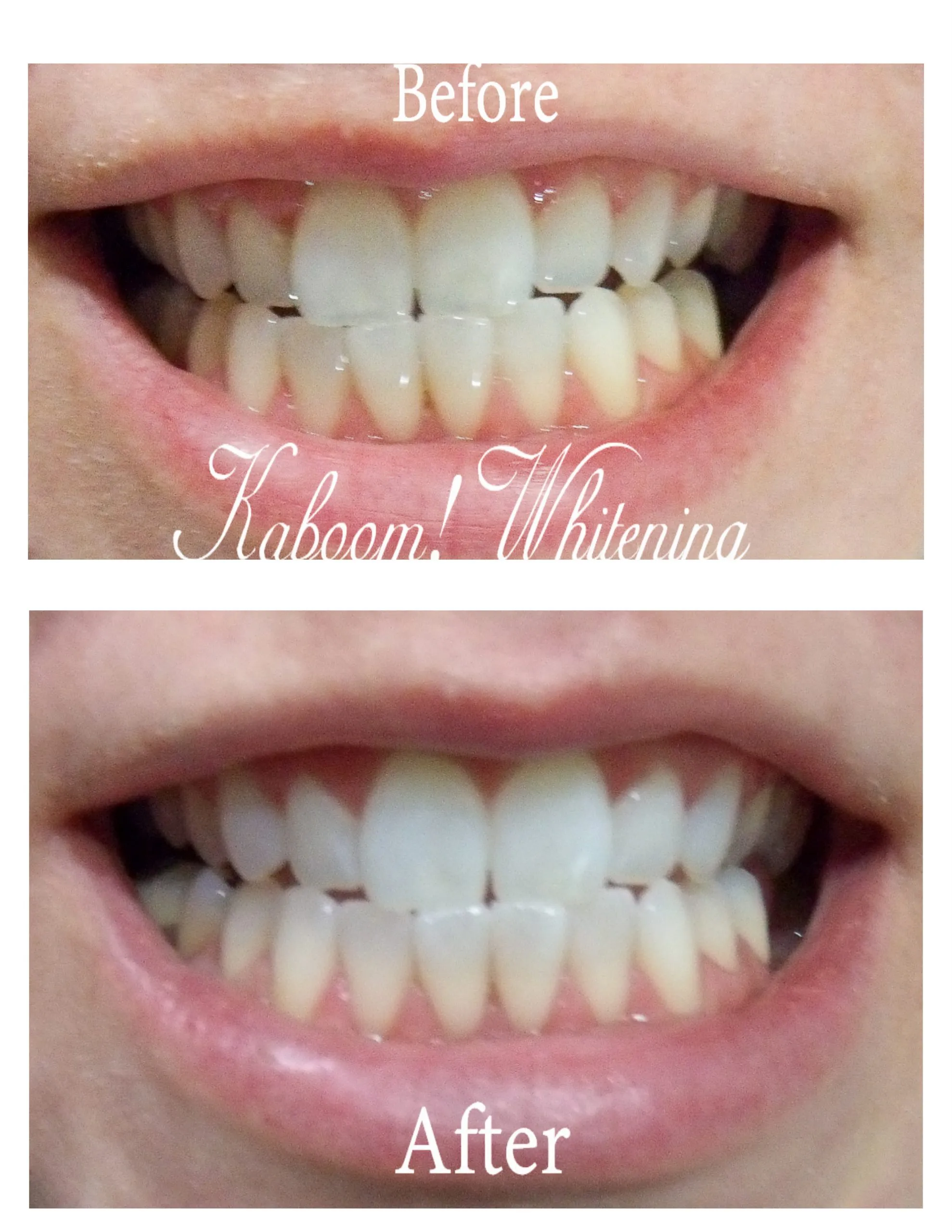 30343 teeth whitening customization