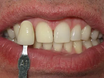 30346 over the counter whitening