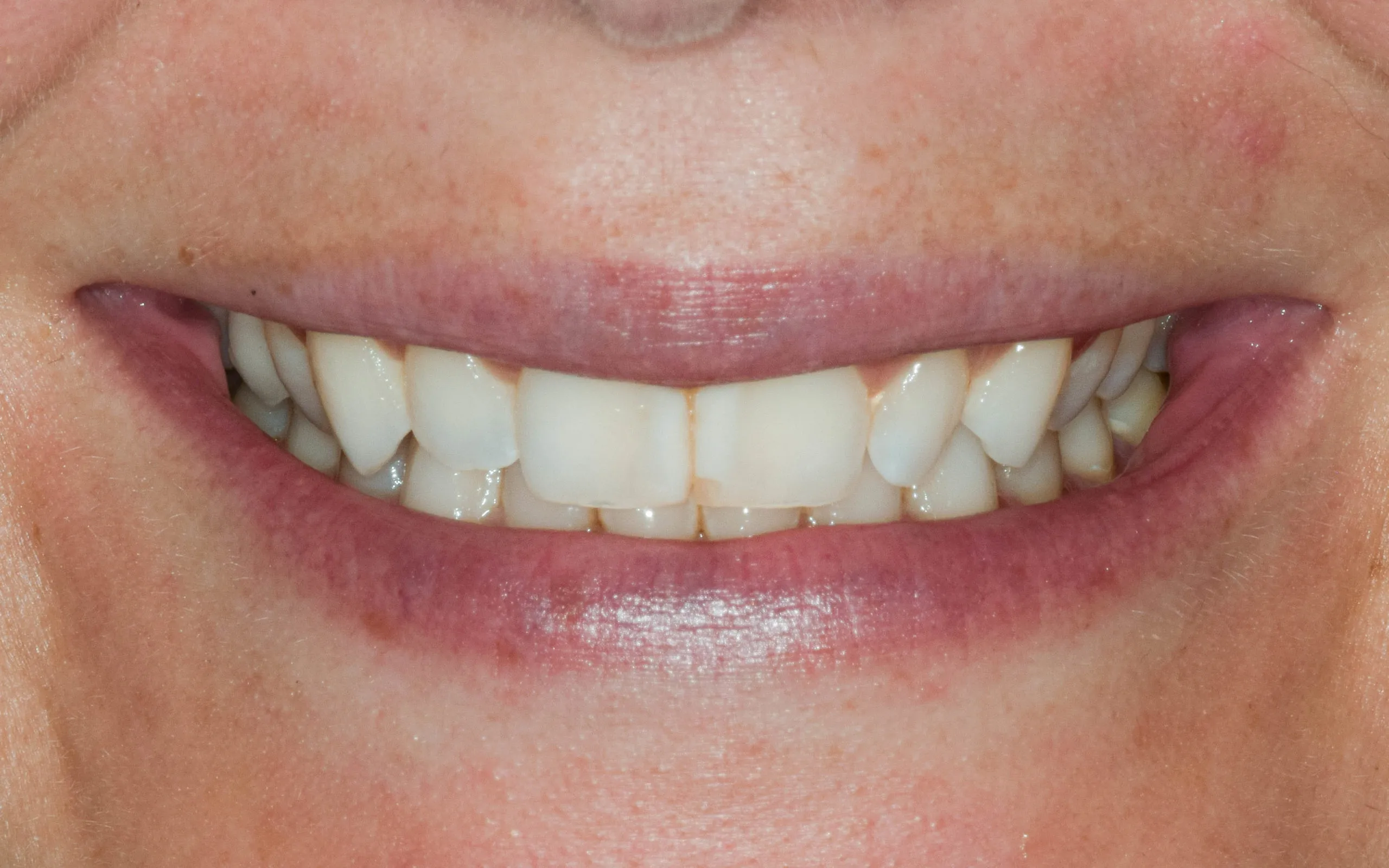 30346 teeth whitening diet