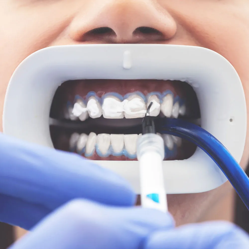 30348 at home teeth whitening