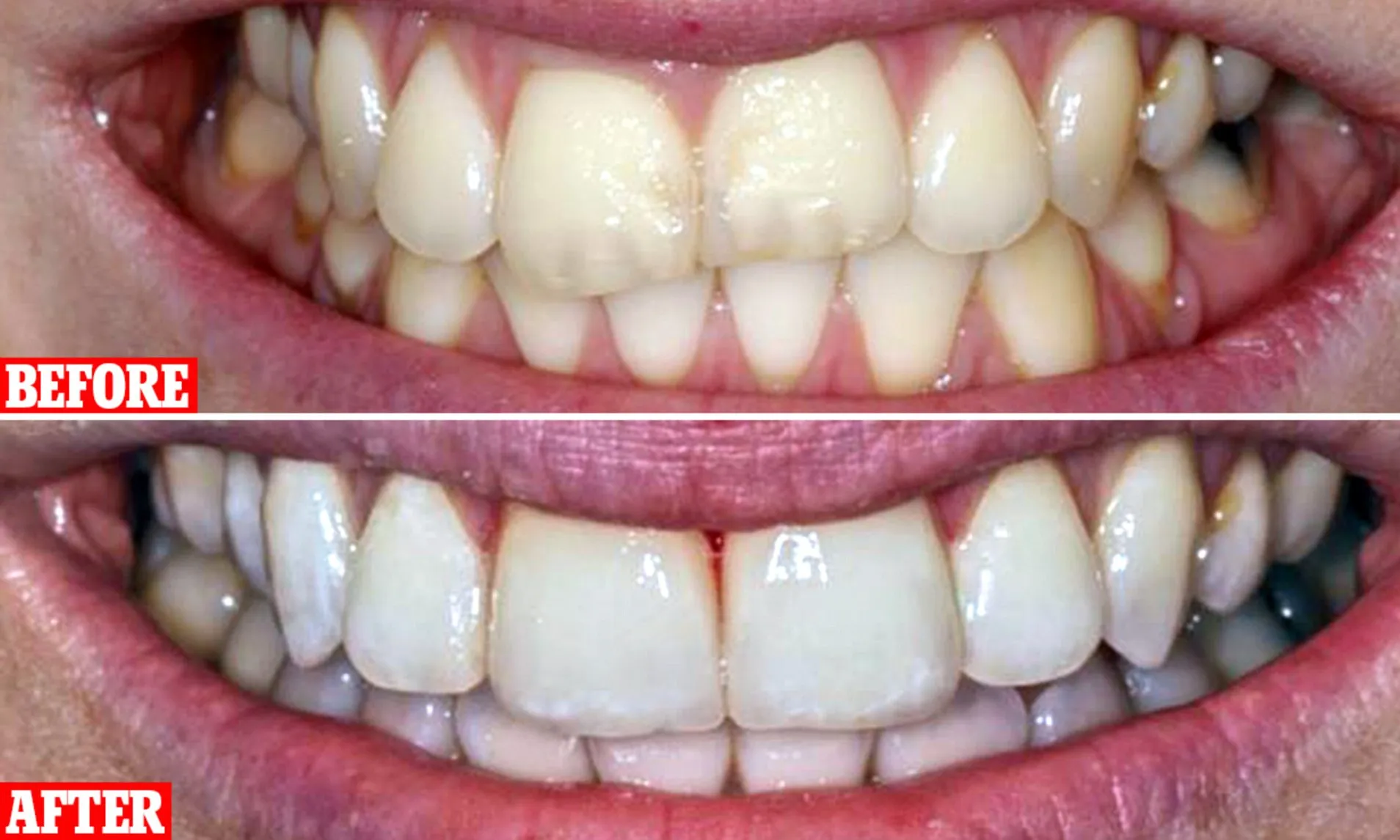 30353 gum irritation