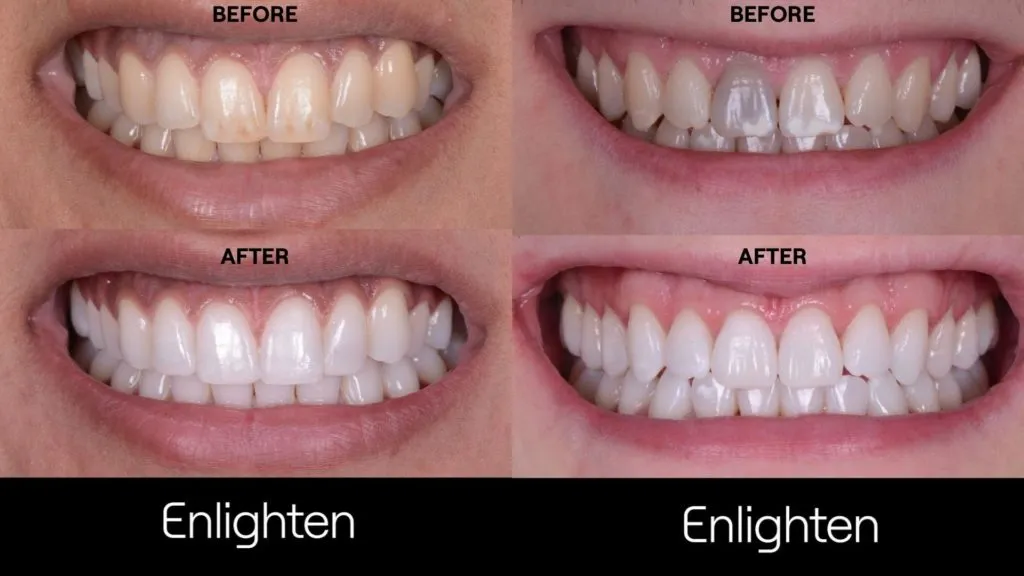 /img/30355-home-teeth-whitening-sensitivity.webp