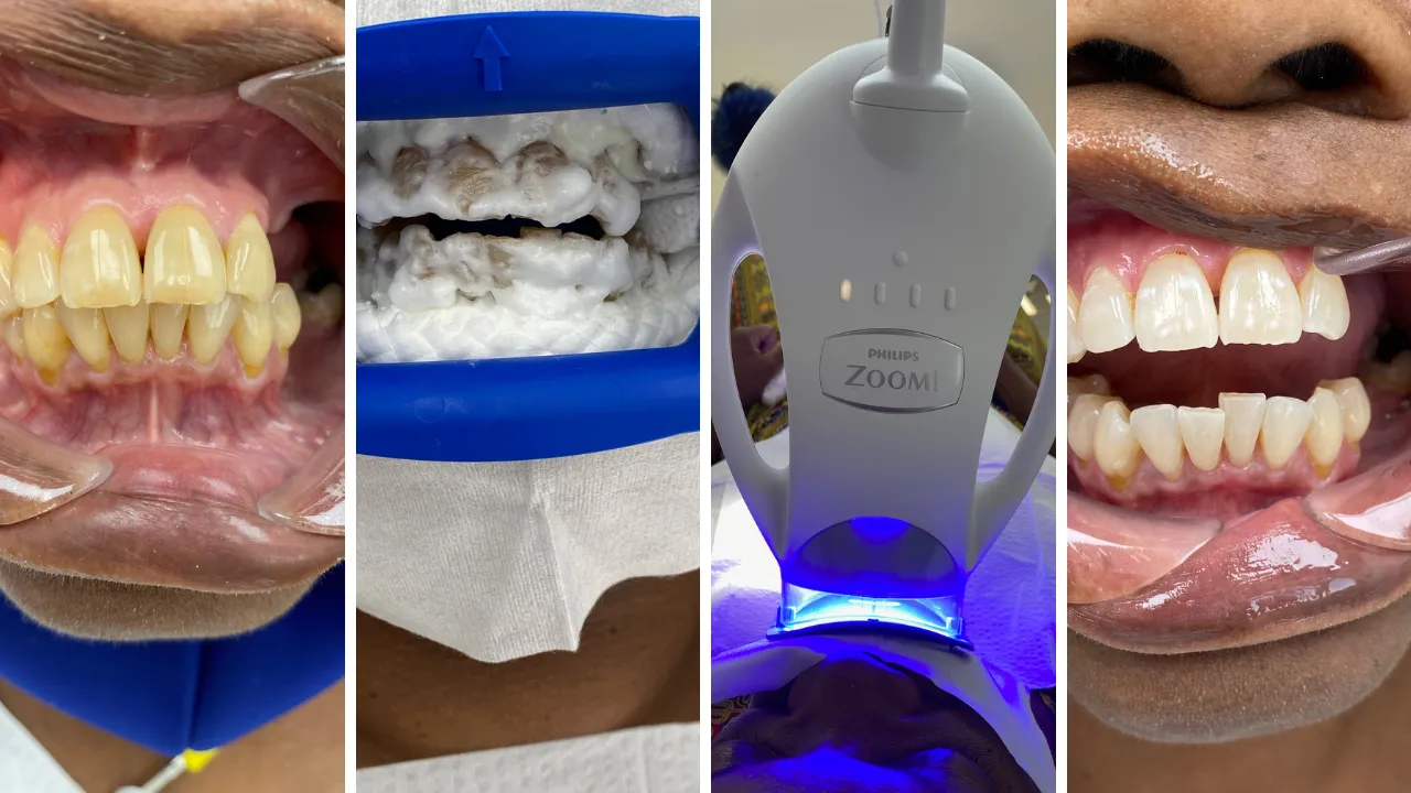 30357 zoom whitening consultation