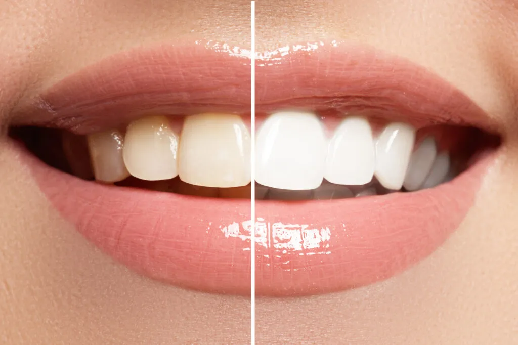 /img/30363-alternative-teeth-whitening.webp